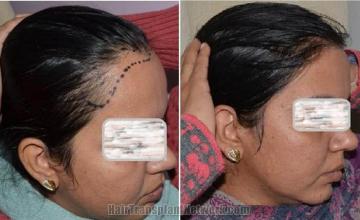 Female hair transplantation surgery before and after images