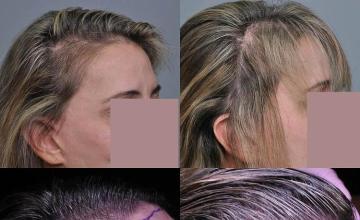 Hair transplantation surgery before and after images