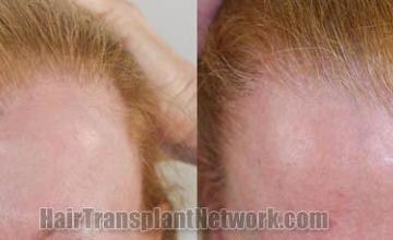 Female hair restoration procedure before and after results