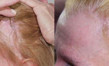Female hair transplantation surgery before and after images
