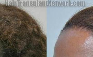 Female hair transplantation surgery before and after photos