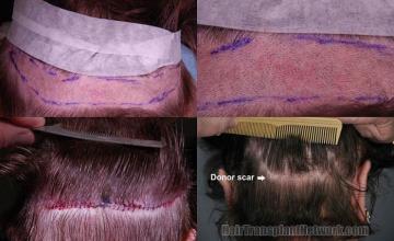 Hair transplantation surgery before and after pictures