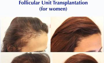 Female hair transplantation surgery before and after images