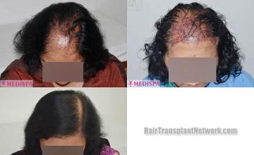 Female hair restoration procedure before and after result photos