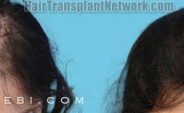 Female hair transplantation procedure before and after result