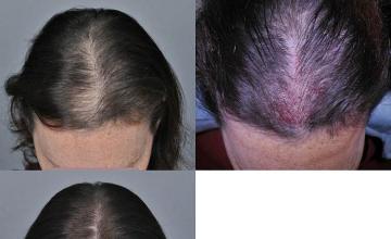 Hair restoration procedure before and after pictures