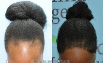 Top view before and after hair restoration results