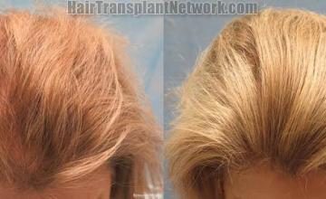 Female hair transplantation surgery before and after images