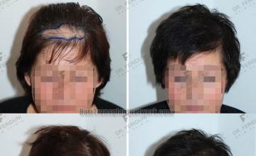 Female before and after photos