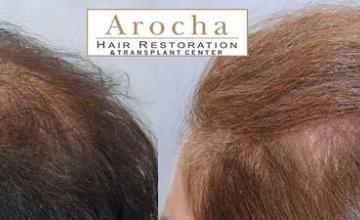 Female hair transplantation surgery before and after images