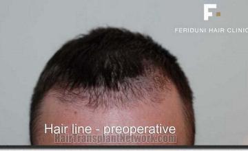 Hair restoration procedure results