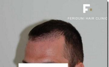 Hair restoration procedure results