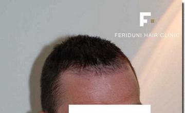 Hair restoration procedure results