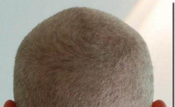 Hair restoration procedure results