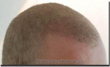 Hair restoration procedure results