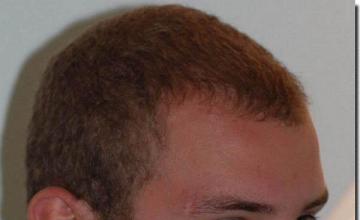 Hair restoration procedure results