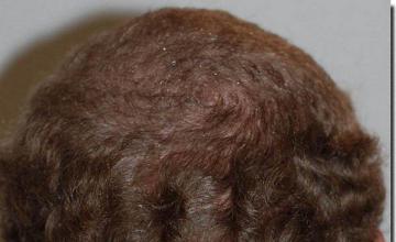 Hair restoration procedure results