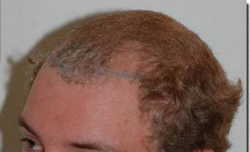 Hair restoration procedure results