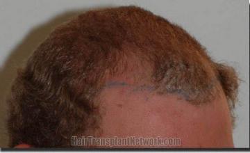 Hair restoration procedure results