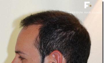 Hair restoration procedure results