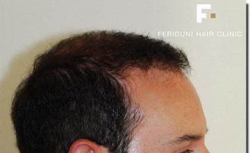 Hair restoration procedure results