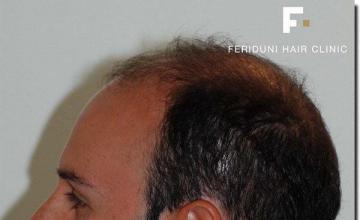 Hair restoration procedure results