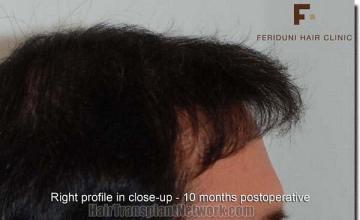 Hair restoration procedure results