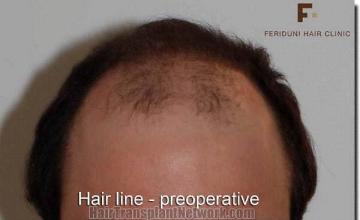 Hair restoration procedure results