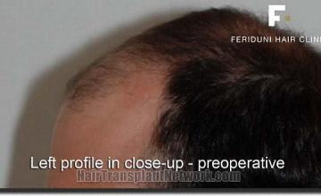 Hair restoration procedure results