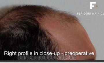 Hair restoration procedure results