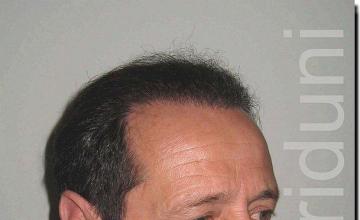 Hair restoration procedure results