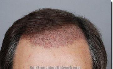 Hair restoration procedure results