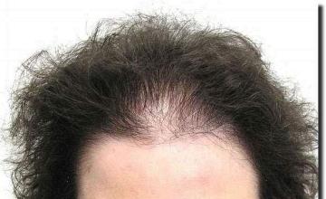 Hair restoration procedure results