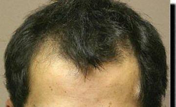 Hair restoration procedure results