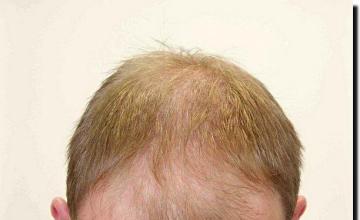 Hair restoration procedure results