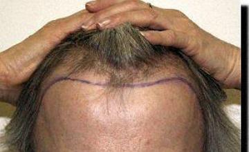 Hair restoration procedure results