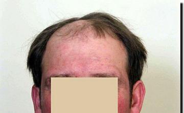 Hair restoration procedure results