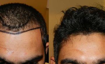 Front - before and after