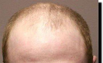 Hair restoration procedure results