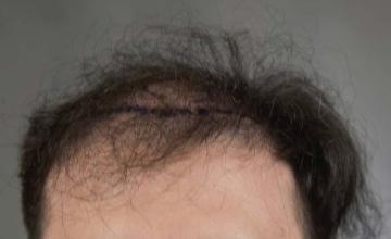 Frontal area before surgery