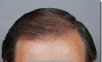 Hair restoration procedure results