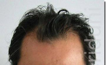 Hair restoration procedure results