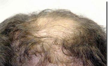 Hair restoration procedure results