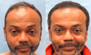 Frontal area before surgery