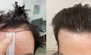 Dr. Kyriakos Maras | Hair transplant before and after photos