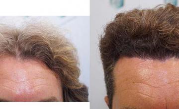 Frontal area before and after surgery