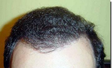 Hair restoration procedure results