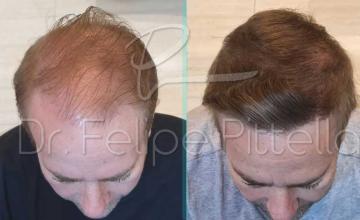 Frontal area before and after hair transplant surgery