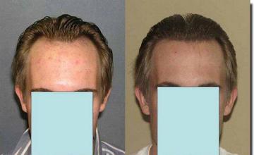 Hair restoration procedure results