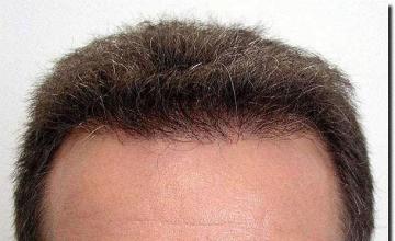 Hair restoration procedure results